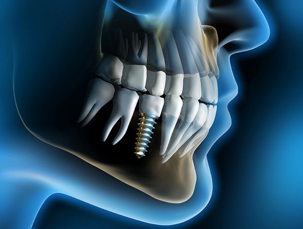 پاسخ به چند سوال متداول در مورد ایمپلنت و کاشت دندان