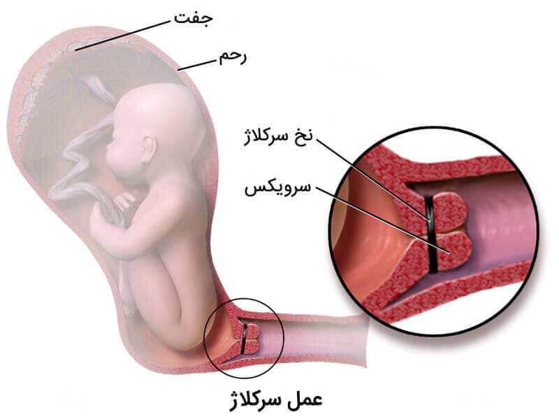 آمادگی برای عمل سرکلاژ