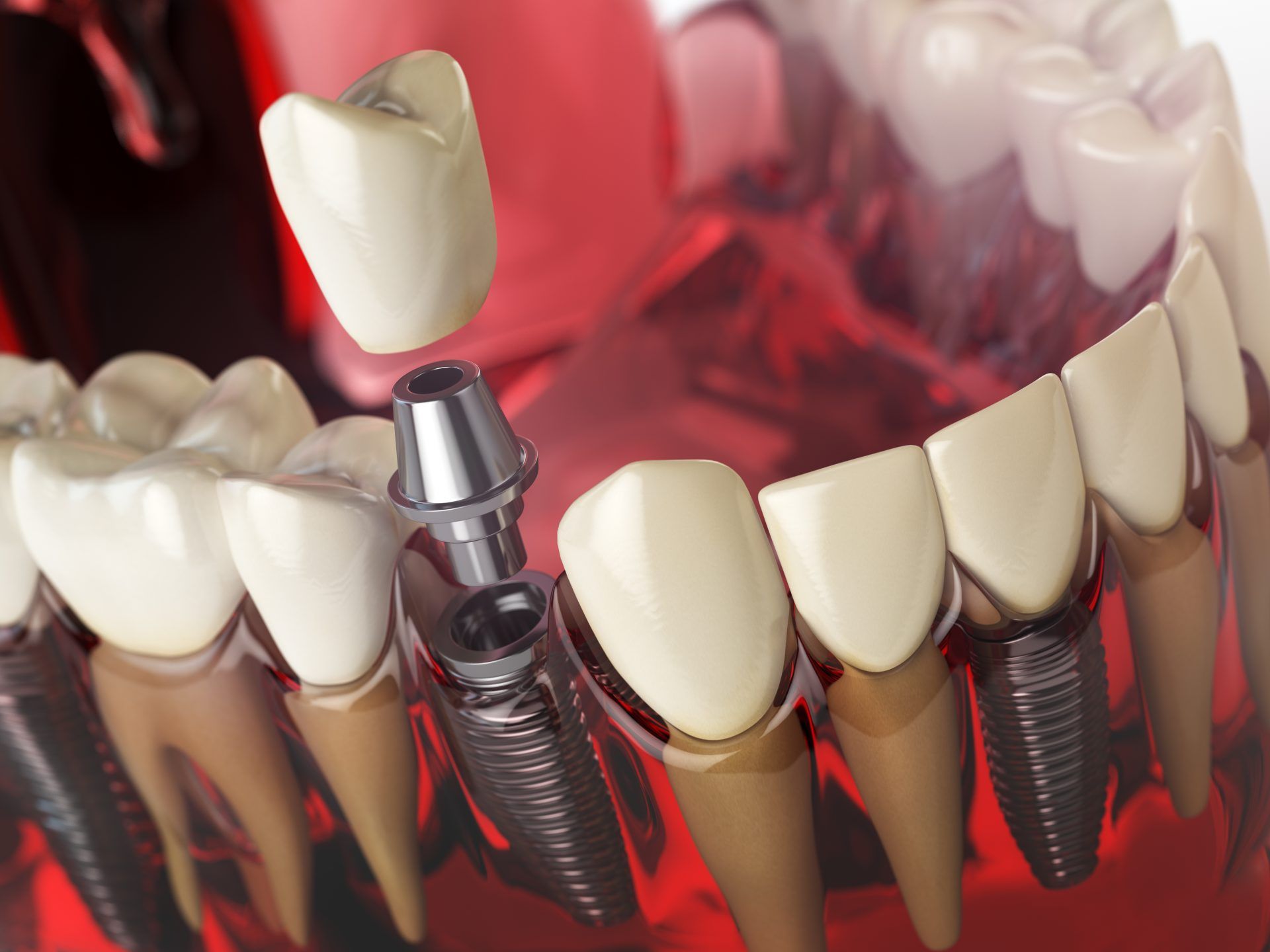 مزایای کاشت ایمپلنت دندان چیست؟