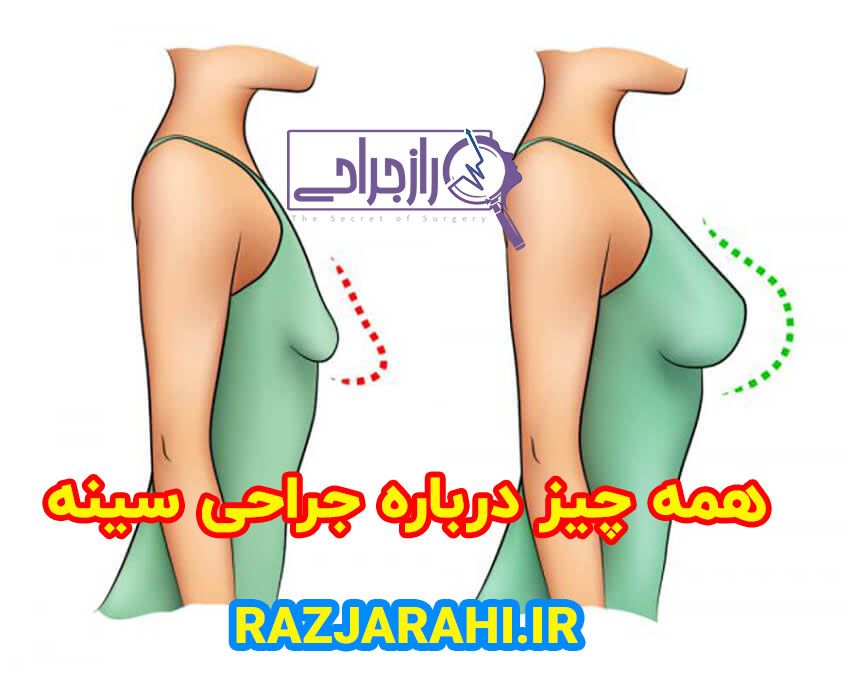 پروتز سینه - راز جراحی