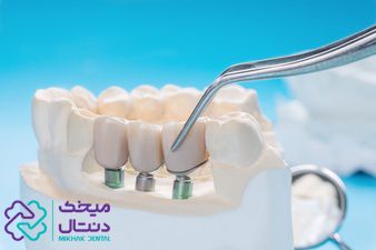 خطرات ایمپلنت دندان