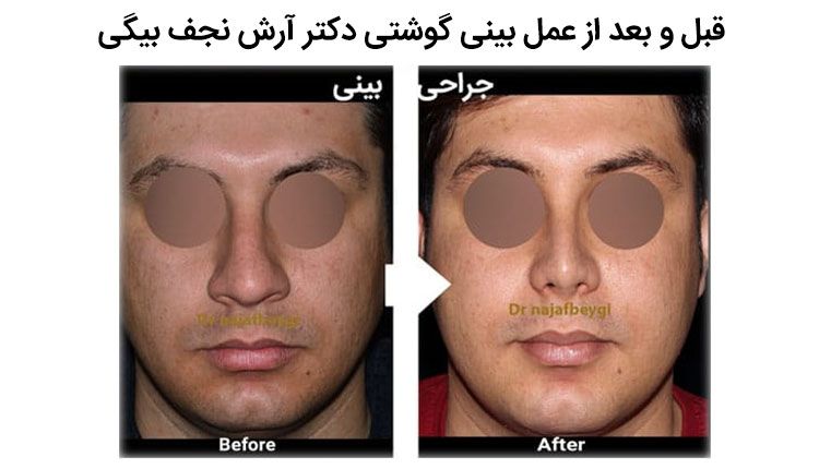 قبل و بعد از عمل بینی گوشتی دکتر آرش نجف بیگی