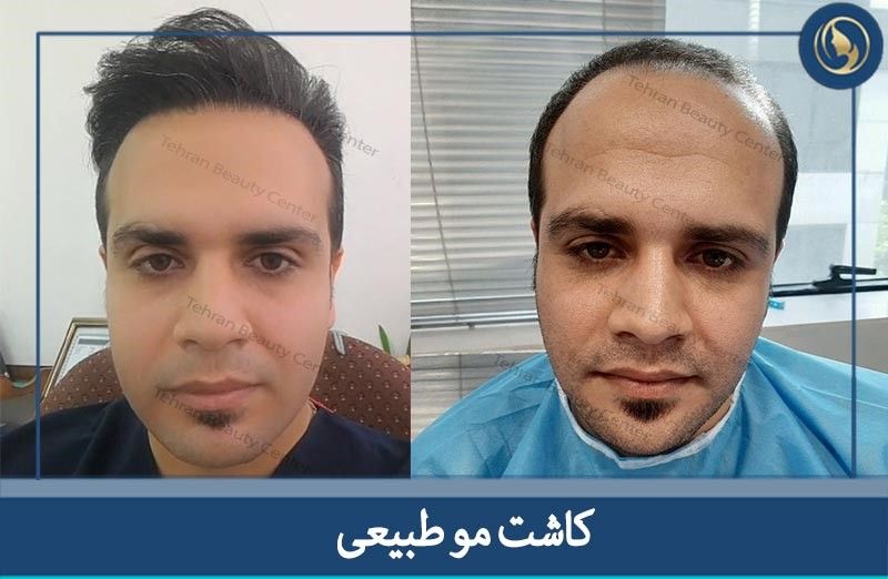 جدیدترین روش کاشت مو در ایران و جهان
