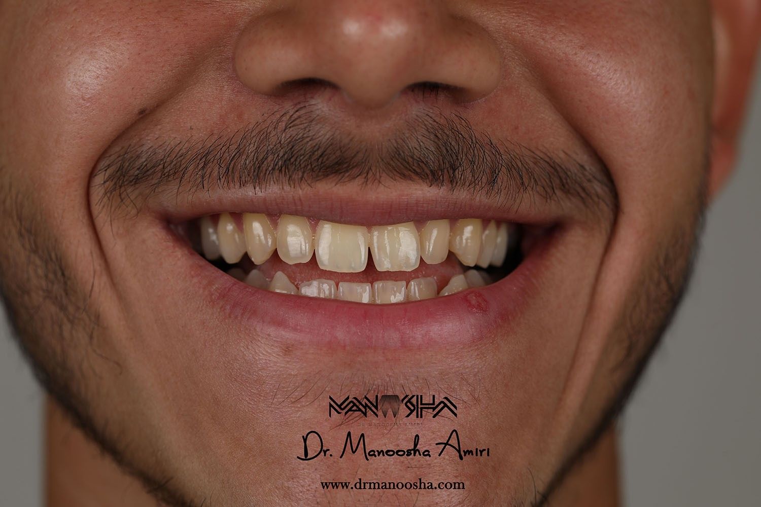 بهترین دندانپزشکی زیبایی در رشت،دکتر مانوشا امیری