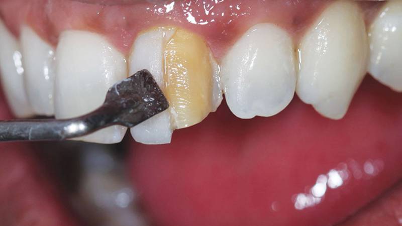 عوامل موثر بر ماندگاری کامپوزیت دندان