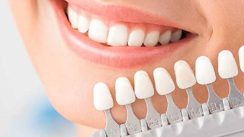 مزایای استفاده از کامپوزیت دندان 