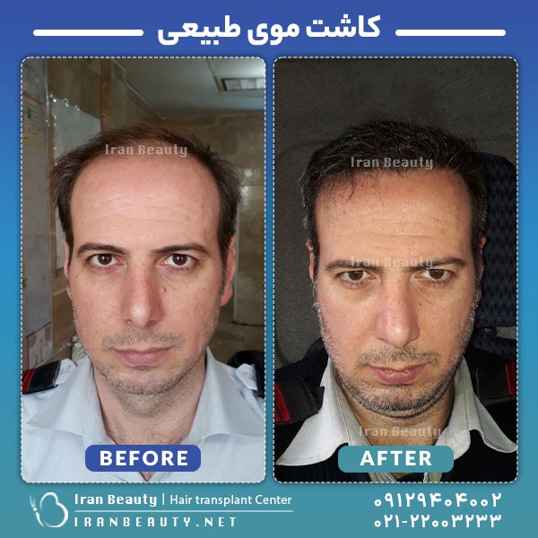 BEFORE AFTER HAIR TRANSPLANT