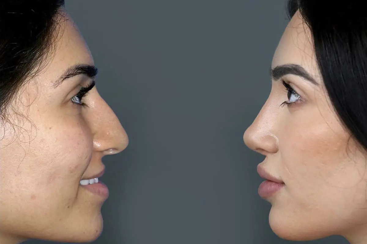 نمونه کار قبل و بعد عمل بینی