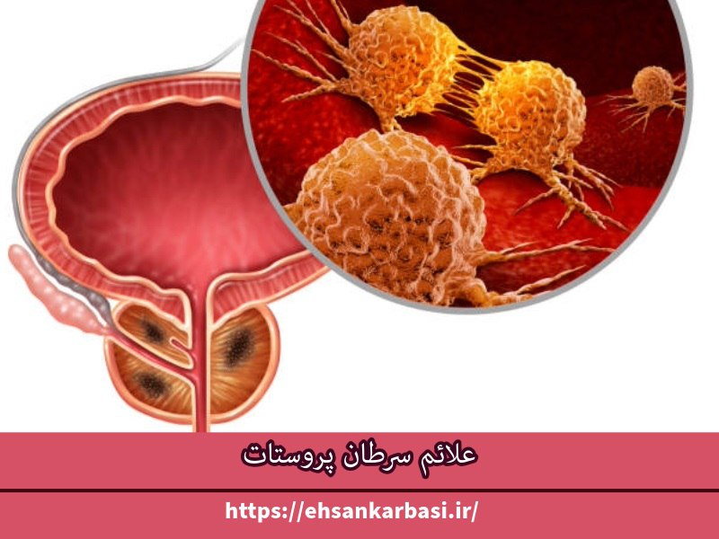 علائم سرطان پروستات