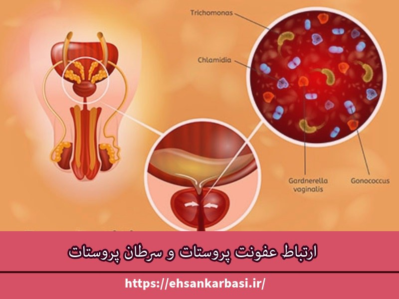  ارتباط عفونت پروستات و سرطان پروستات