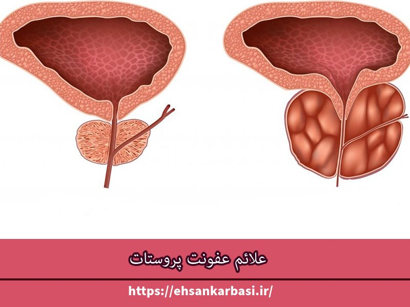  علائم عفونت پروستات