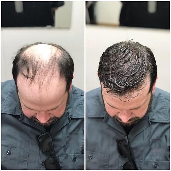 قبل و بعد از کاشت مو