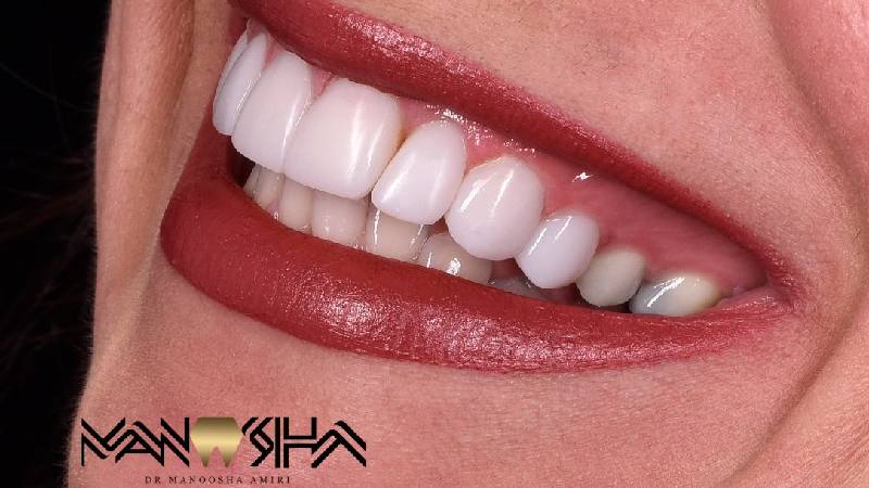 موارد استفاده از روکش تمام سرامیک