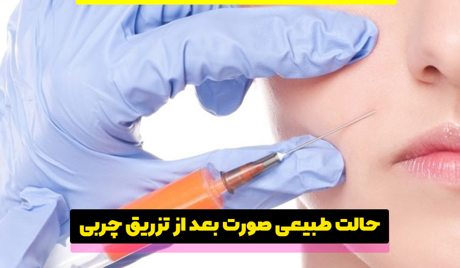 چند روز بعد از تزریق چربی صورت به حالت طبیعی برمیگردد؟