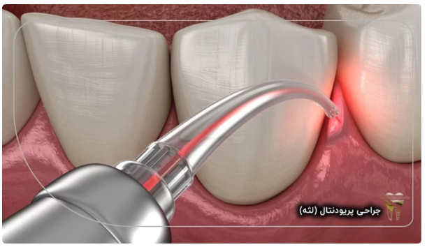 جراحی پریودنتال (لثه) دندانپزشکی قاسمی