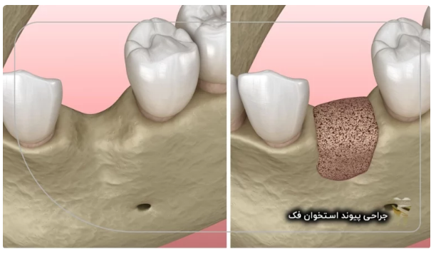 جراحی پیوند استخوان فک توسط دکتر سیروس قاسمی