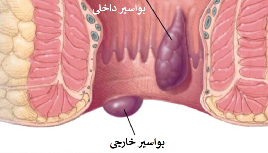 تصویر از علائم بیماری هموروئید