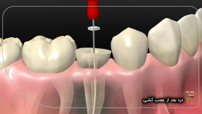 کاهش عوارش عصب کشی با دکتر قاسمی