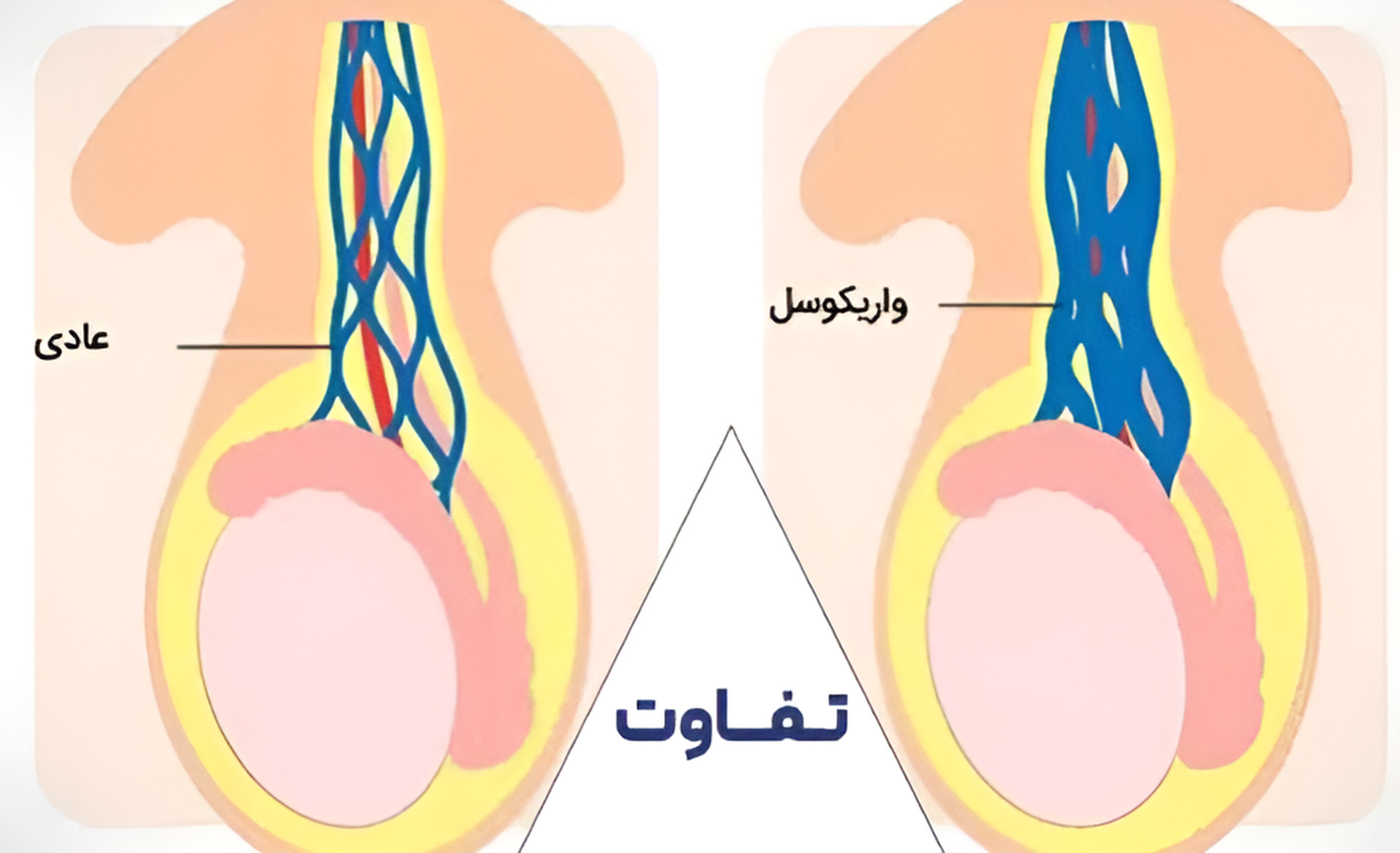 تفاوت عادی و واریکوسل