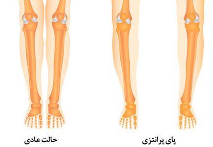 مقایسه پای پرانتزی و پای عادی