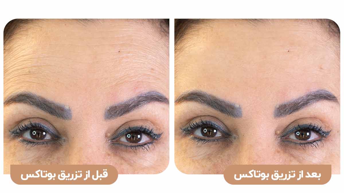 قبل و بعد از تزریق بوتاکس در کلینیک سلامت ایده آل