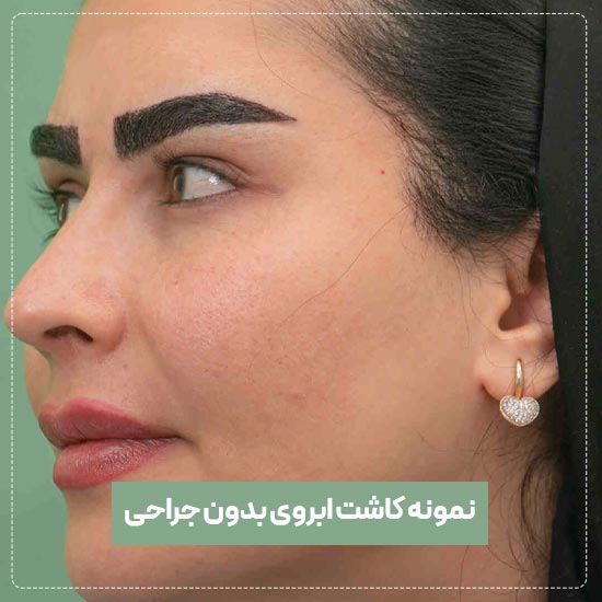 کاشت ابروی بدون جراحی