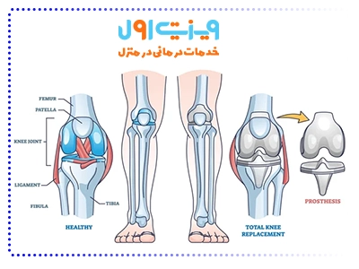 برنامه درمانی برای بیماران تعویض کامل مفصل زانو