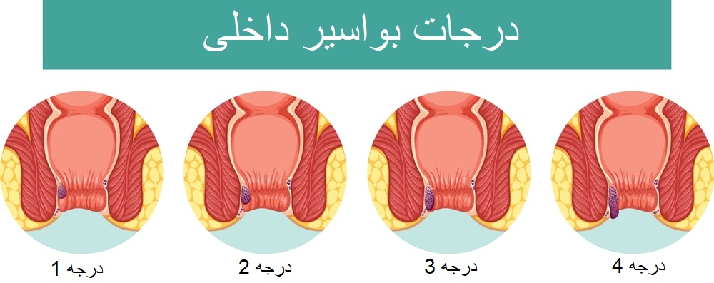 درجات بواسیر داخلی