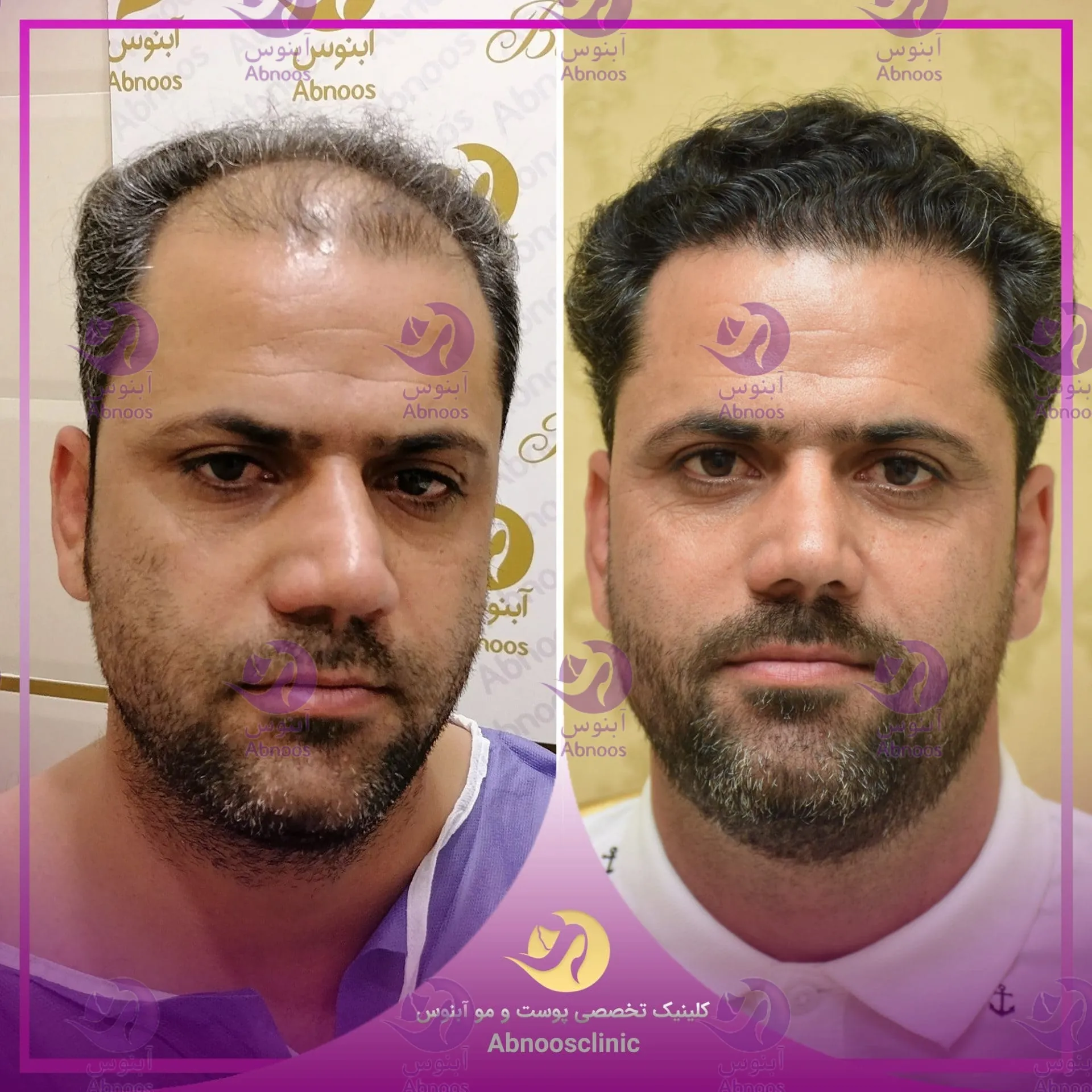 کاشت مو مشهد