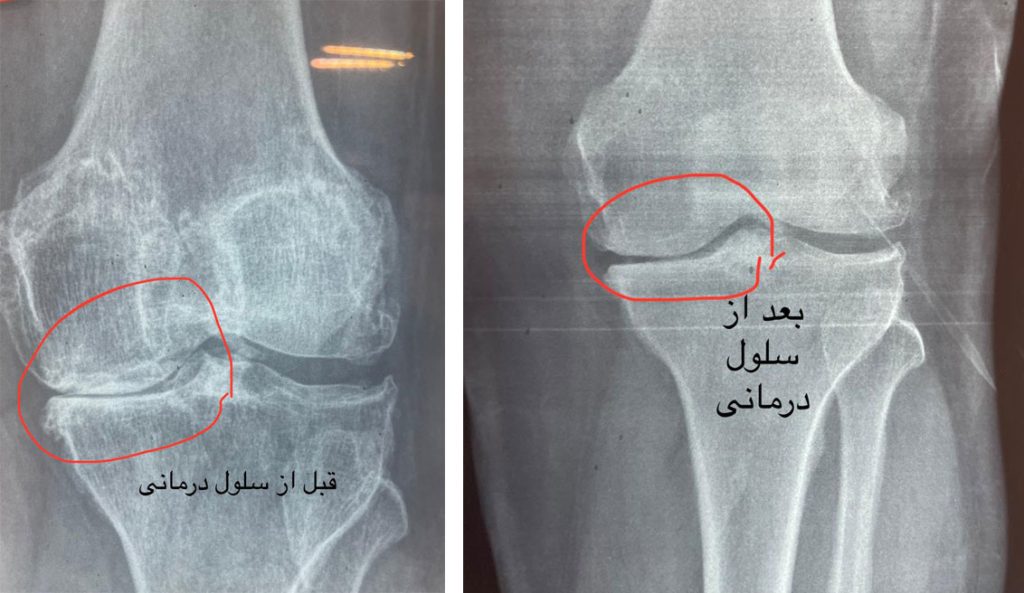 قبل و بعد سلول درمانی زانو