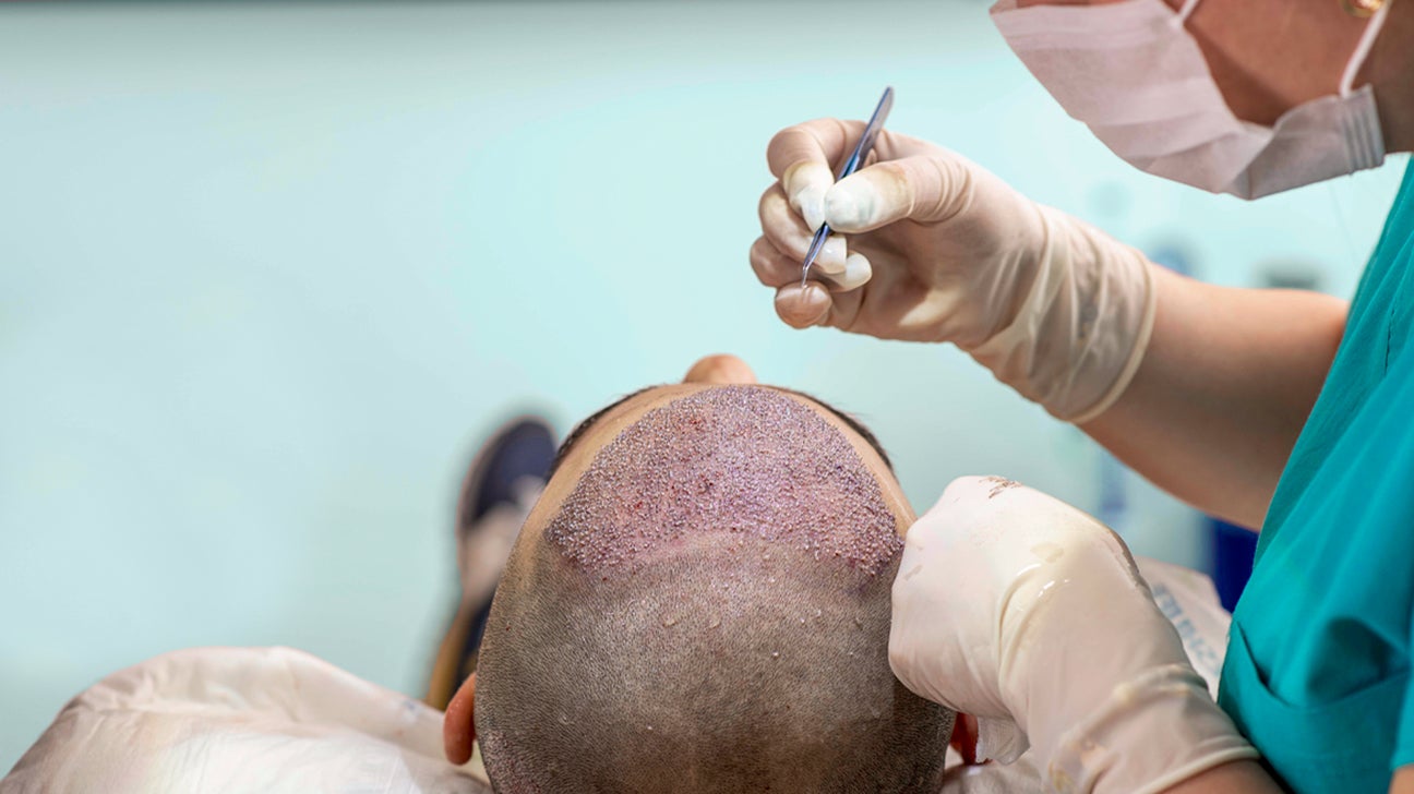 بهترین روش و مدل کاشت مو بین فوتبالیست های ایرانی | کلینیک نیل فروش زاده