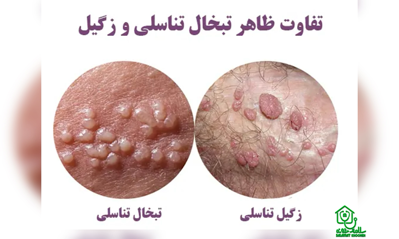 تبخال تناسلی چیست