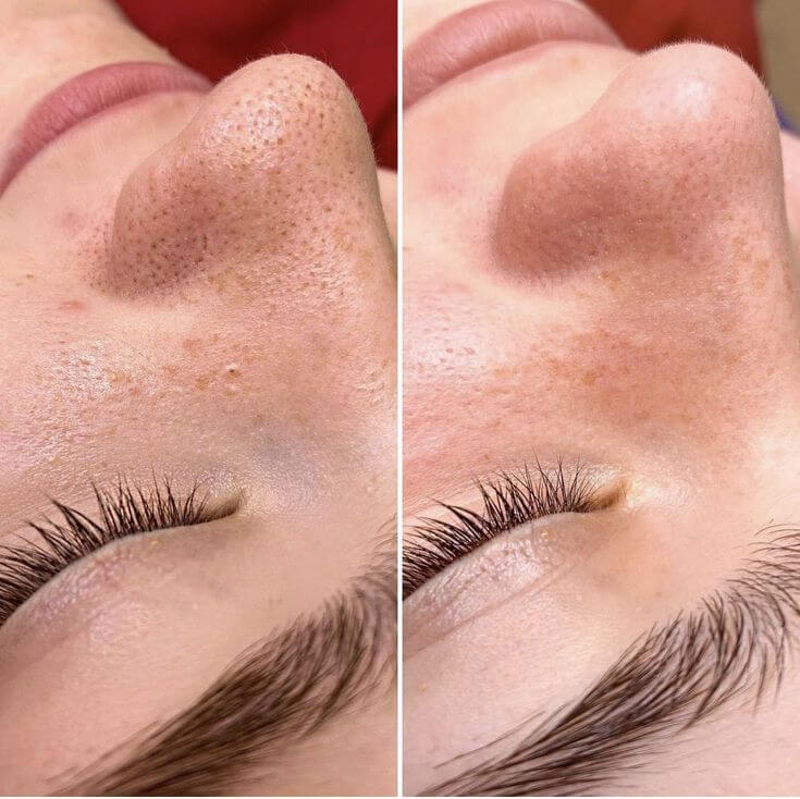 پاکسازی تخصصی پوست
