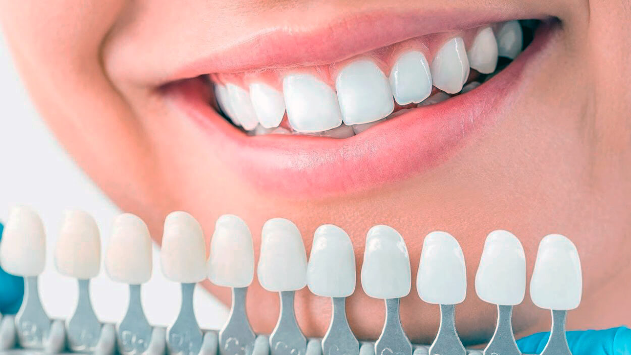 آیا لمینت دندان بهتر است یا کامپوزیت ؟
