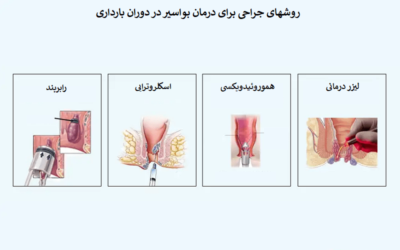 درمان های پزشکی برای بواسیر در بارداری