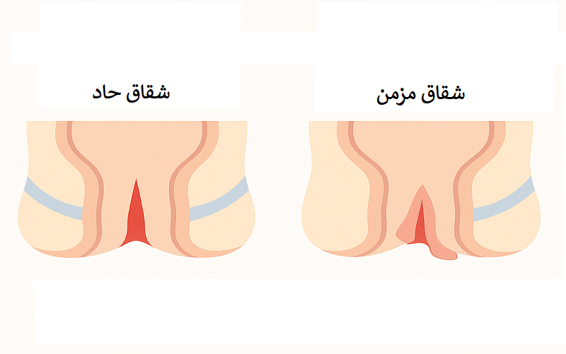 انواع شقاق