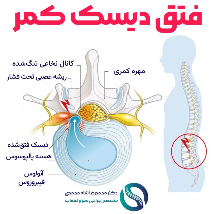 بهترین روش درمان دیسک کمر از نظر متخصص عمل جراحی دیسک کمر در تهران
