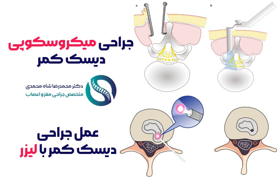 بهترین روش درمان دیسک کمر از نظر متخصص عمل جراحی دیسک کمر در تهران