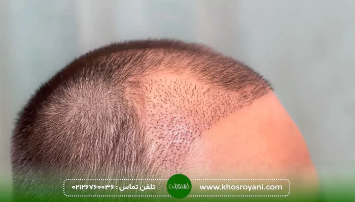 کاشت مو