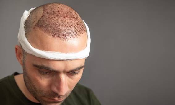 مراقبت های پس از کاشت مو