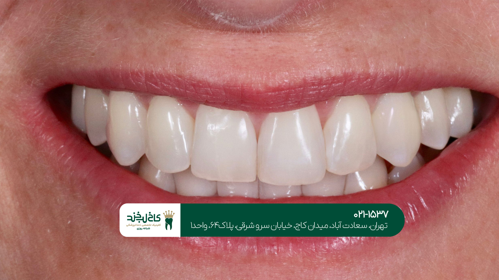 لمینت دندان