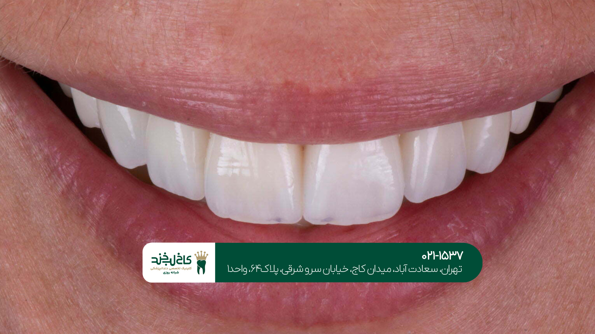 لمینت