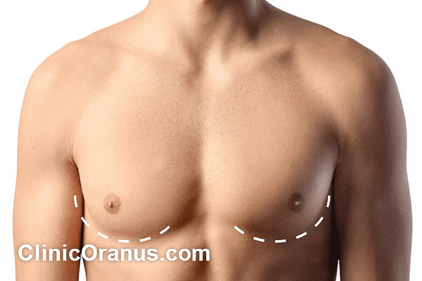 چرا برای درمان ژنیکوماستی باید به کلینیک اورانوس برویم؟ | کلینیک اورانوس