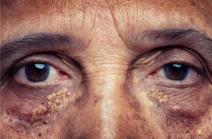 بیماری خاموش چیست؟ از کدام بیماری به عنوان قاتل خاموش یاد میشود؟