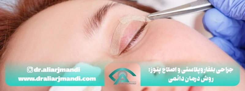 درمان افتادگی پلک