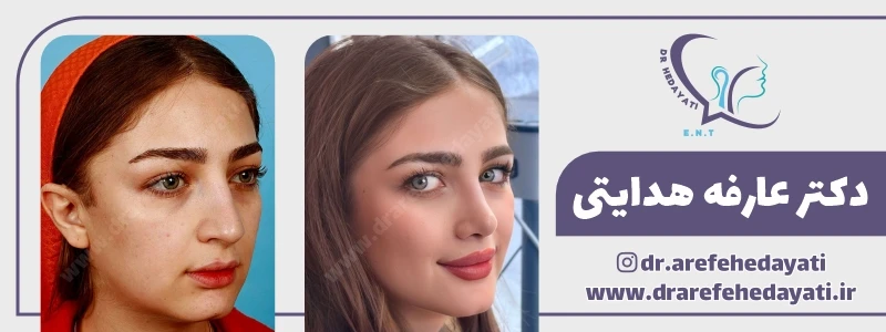 نمونه کار بهترین جراح بینی در کرمانشاه