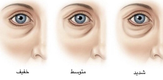 گودی و سیاهی زیر چشم؛ علت و راهکارهای رفع آن