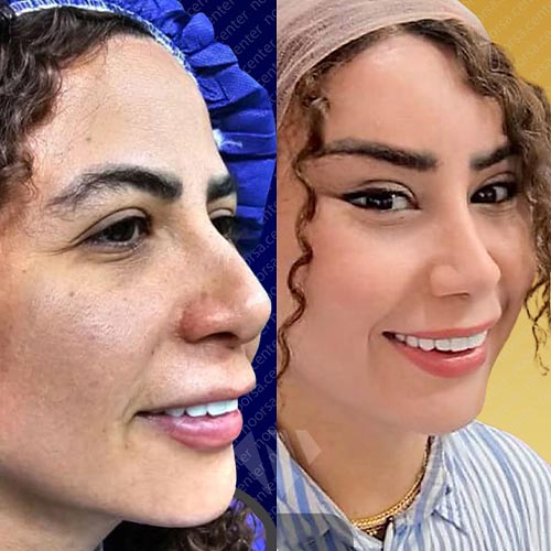 قبل و بعد از جراحی بینی ترمیمی