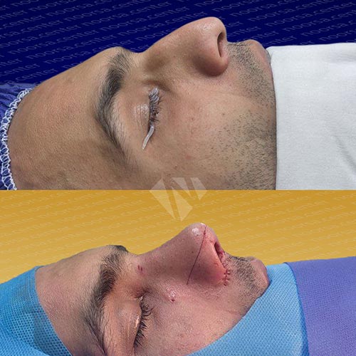 قبل و بعد از عمل بینی