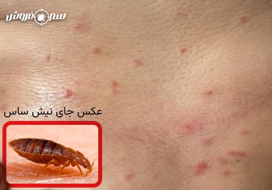 عکس بدن یک فرد با گزش یا نیش ساس - عکس جای نیش ساس